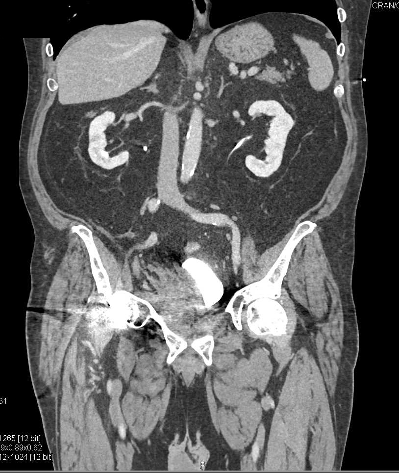 Pelvic Bleed Pushes on the Bladder - CTisus CT Scan