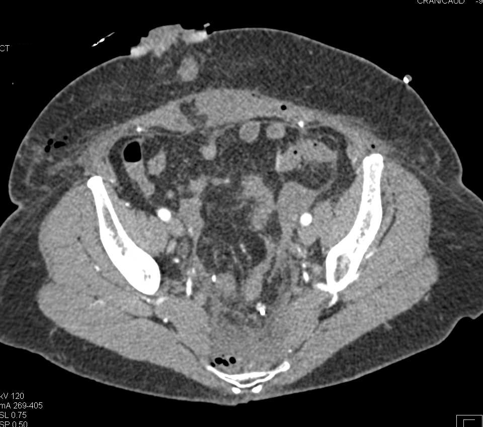 Presacral Abscess in a Post Operative Patient - CTisus CT Scan