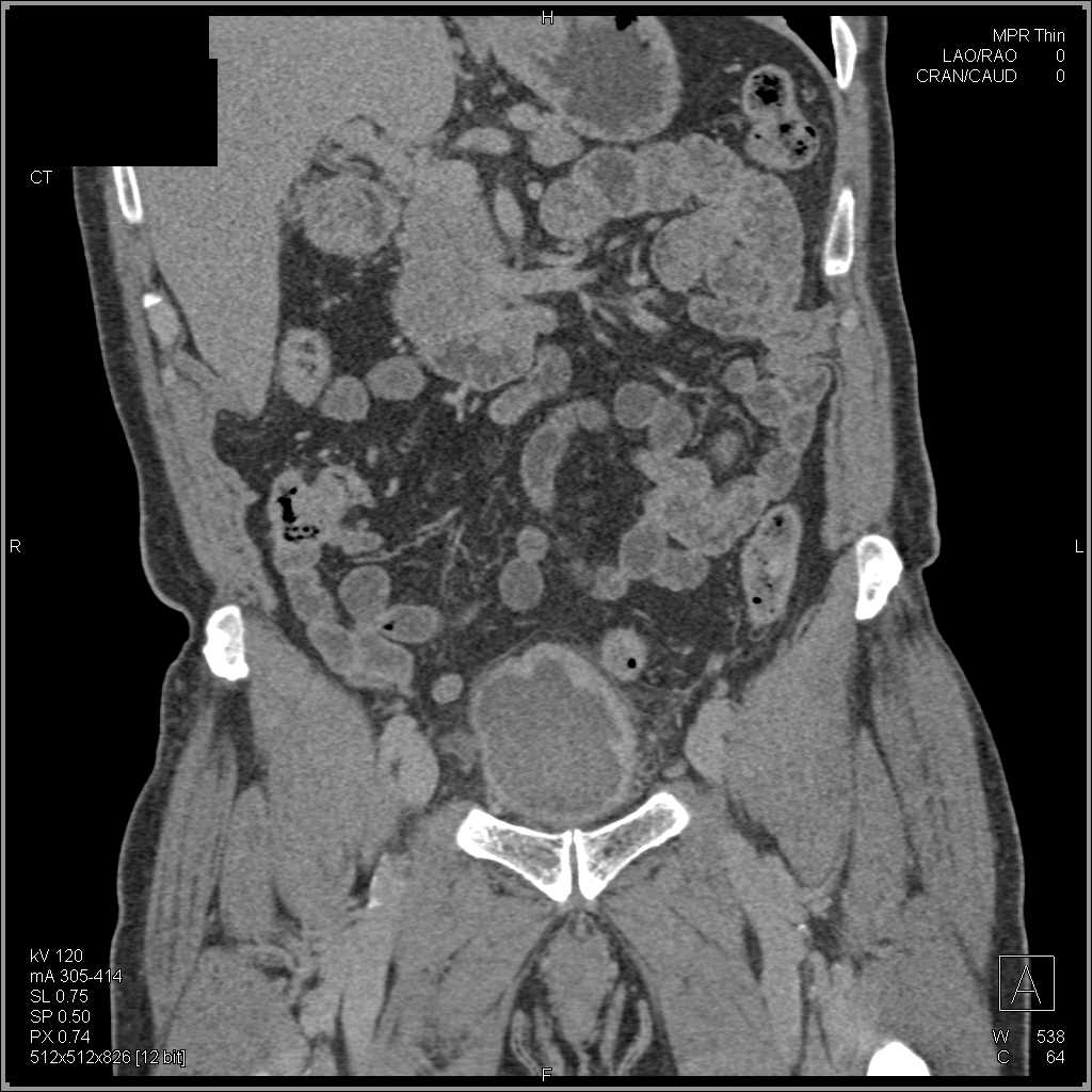 Infiltrating and Enhancing Bladder Cancer - CTisus CT Scan