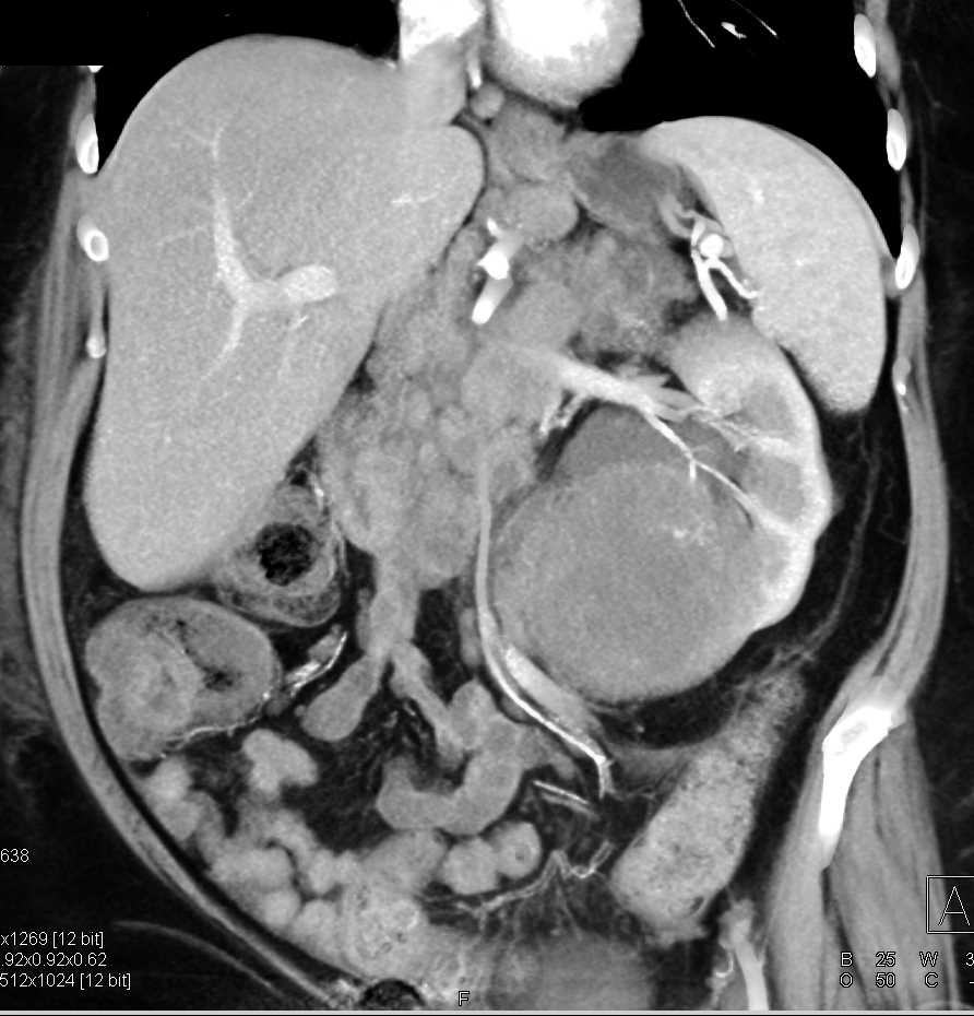 Extensive Adenopathy from Renal Cell Carcinoma - CTisus CT Scan