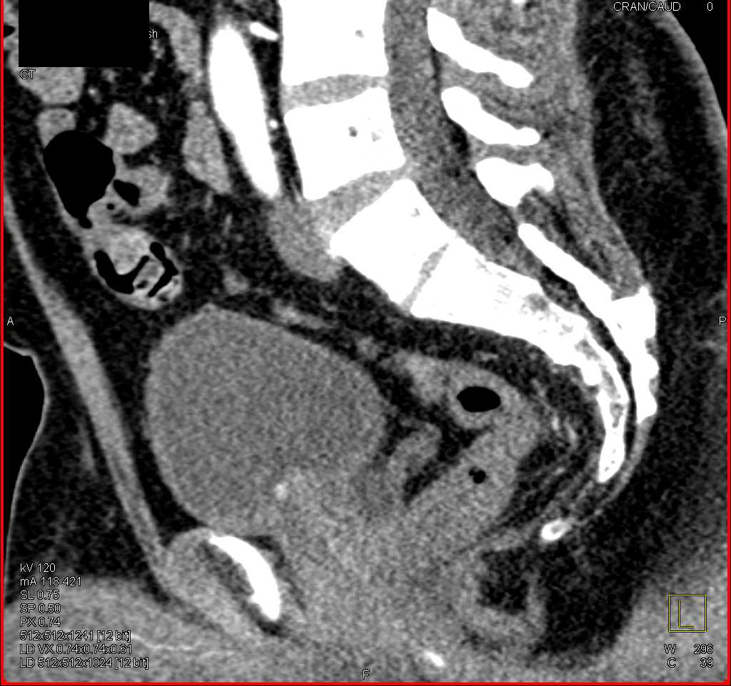 Incidental Bladder Cancer That Enhances - CTisus CT Scan