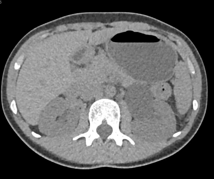 Obstruction with Tumor at the Left Ureterovesical Junction (UVJ) - CTisus CT Scan