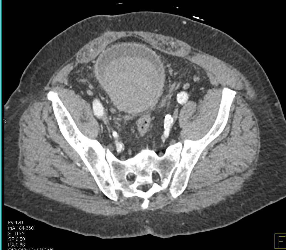 Large Bladder Hematoma - CTisus CT Scan