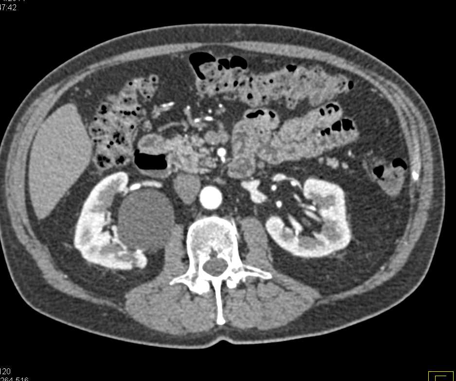 Incidental Bladder Cancer on the Left Wall of the Bladder - CTisus CT Scan