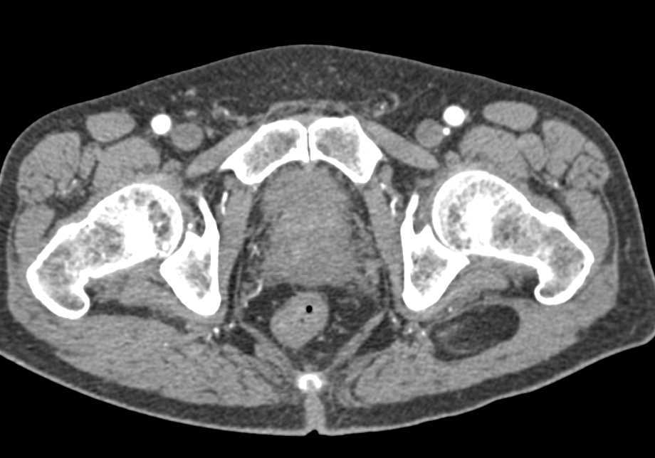 Incidental Bladder Cancer on the Left Wall of the Bladder - CTisus CT Scan