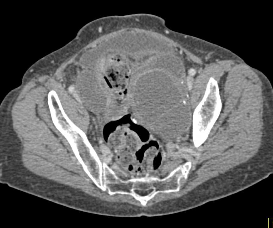 Incidental Bladder Cancer in Patient with Pelvic mass - CTisus CT Scan