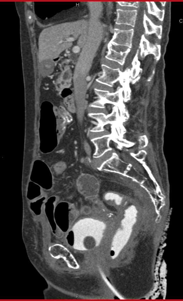 CT Cystogram with Fistulae from Bladder to Colon - CTisus CT Scan