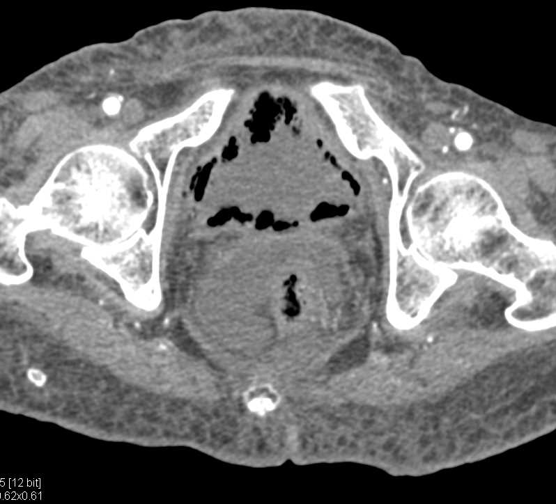 Emphysematous Cystitis - CTisus CT Scan