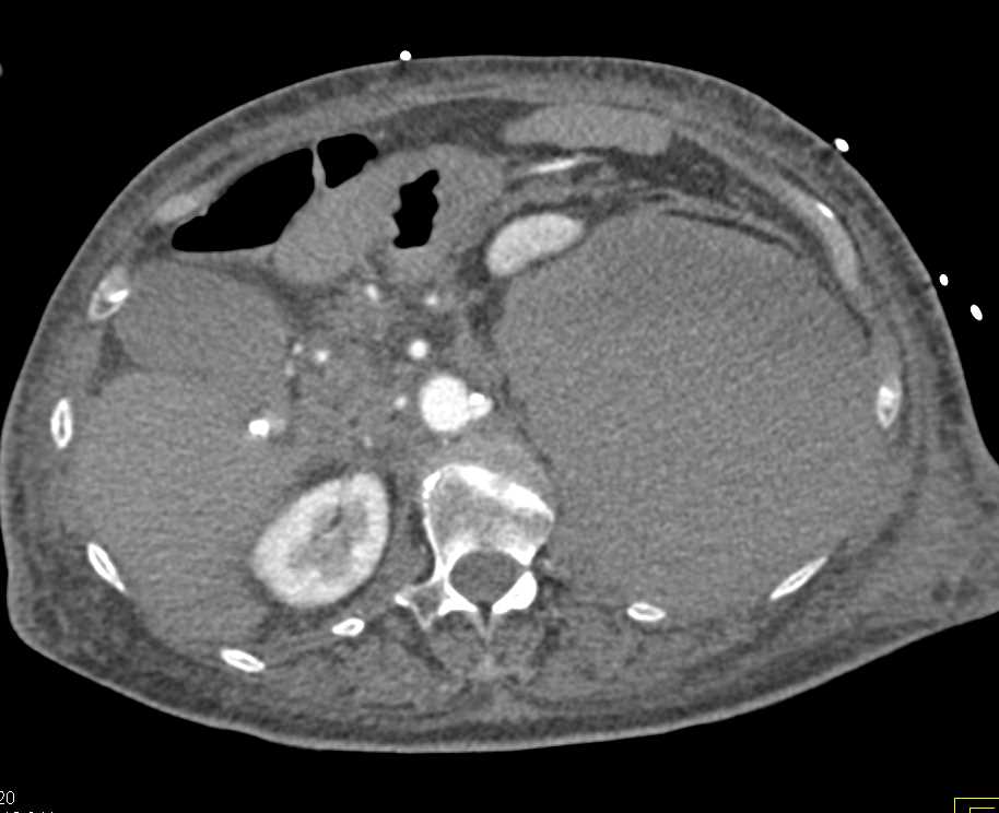 Active Bleed in Retroperitoneum on the Left - CTisus CT Scan