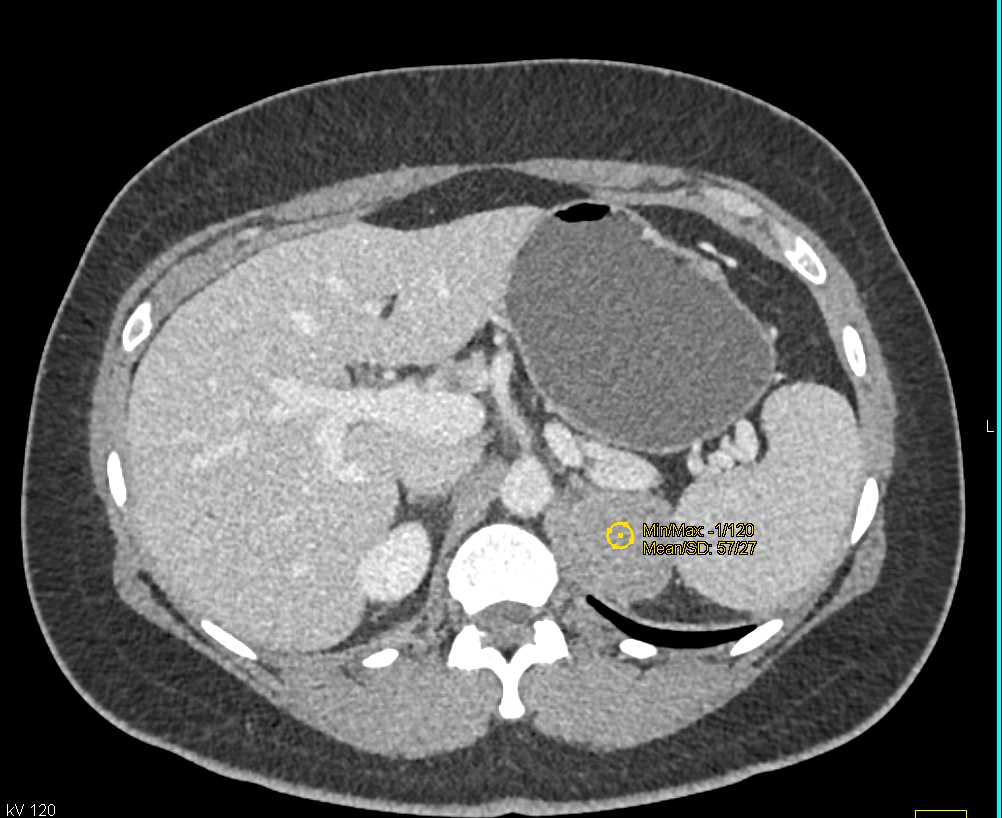 Neurogenic Tumor Left Adrenal - CTisus CT Scan