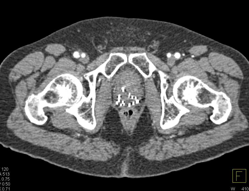 Seed From Prostate Cancer Track  into the Bladder - CTisus CT Scan