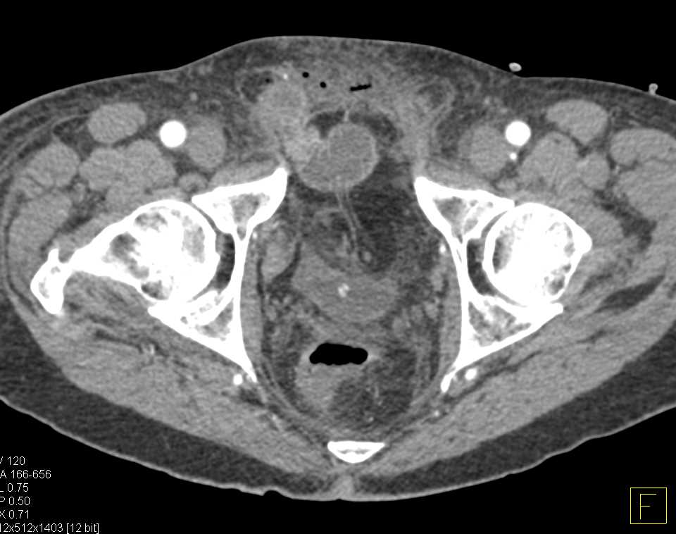 Abscess in Soft Tissues Pelvis - CTisus CT Scan