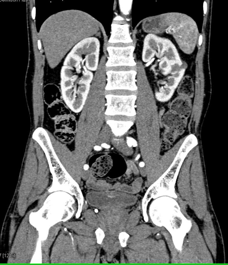 Subtle Bladder Cancer - CTisus CT Scan