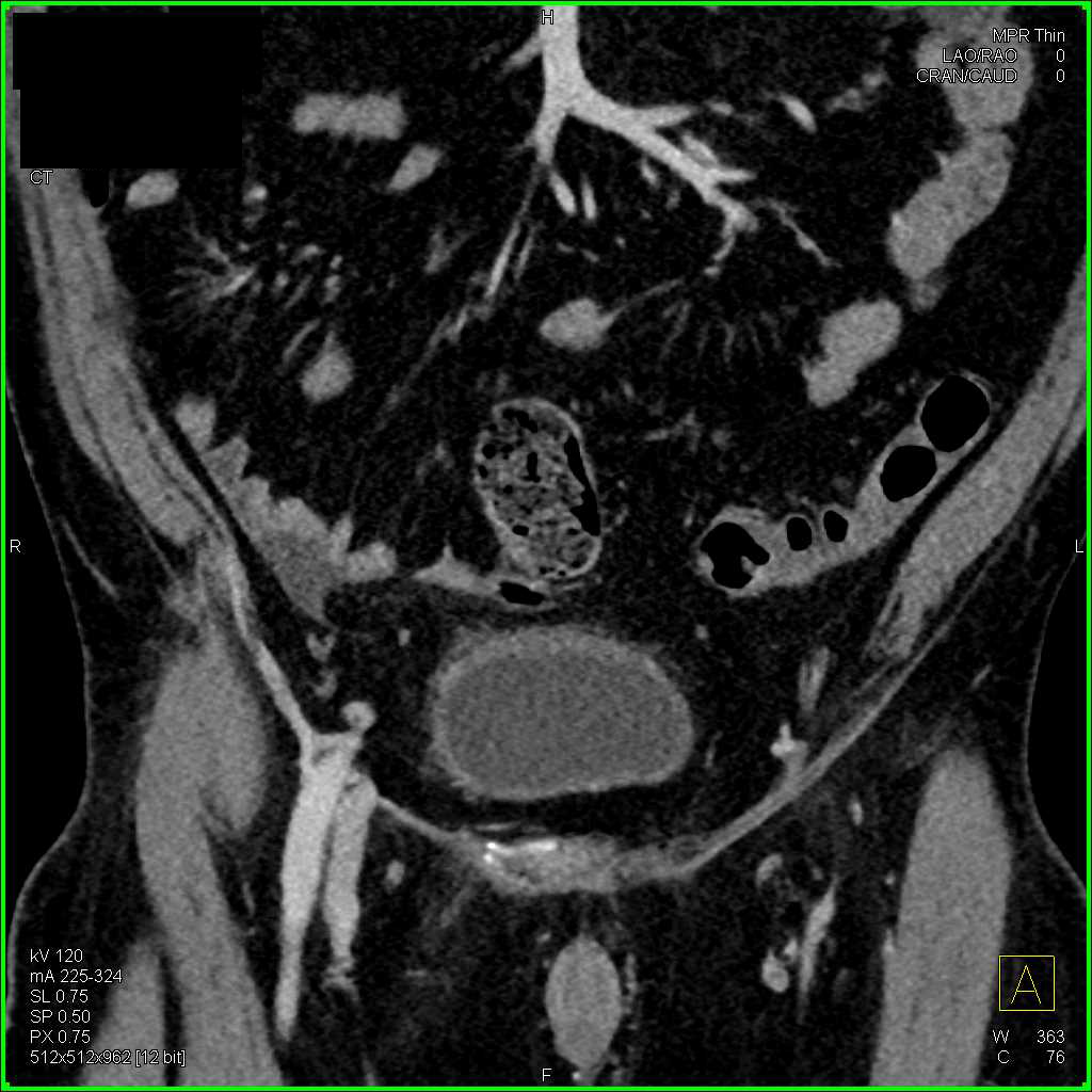 Infiltrating and Enhancing Bladder Cancer - CTisus CT Scan