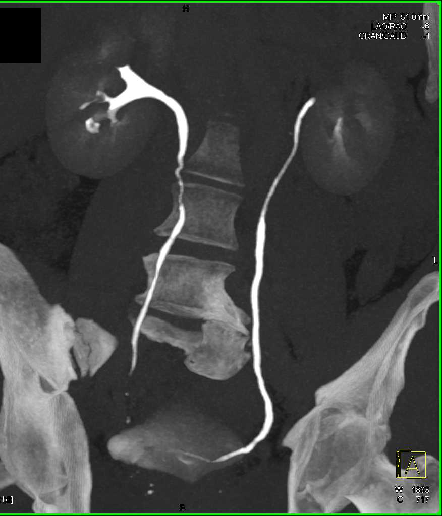 Transitional Cell Carcinoma Right Ureter - CTisus CT Scan