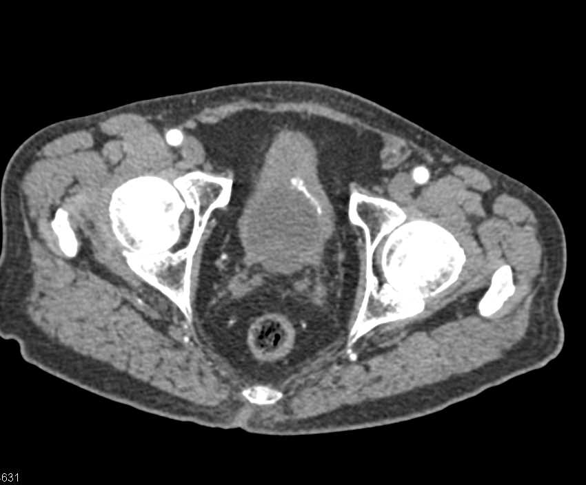 Bladder Cancer with Faint Calcifications - CTisus CT Scan