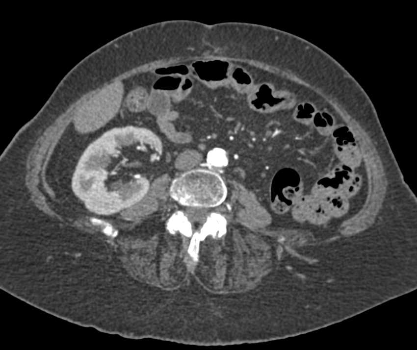 Bladder Cancer in Patient with Prior Nephrectomy for Transitional Cell Cancer (TCC) - CTisus CT Scan