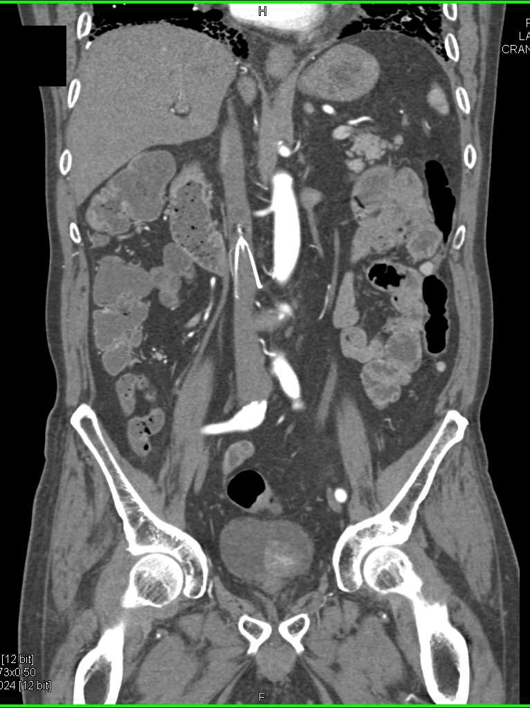 Incidental Bladder Cancer - CTisus CT Scan