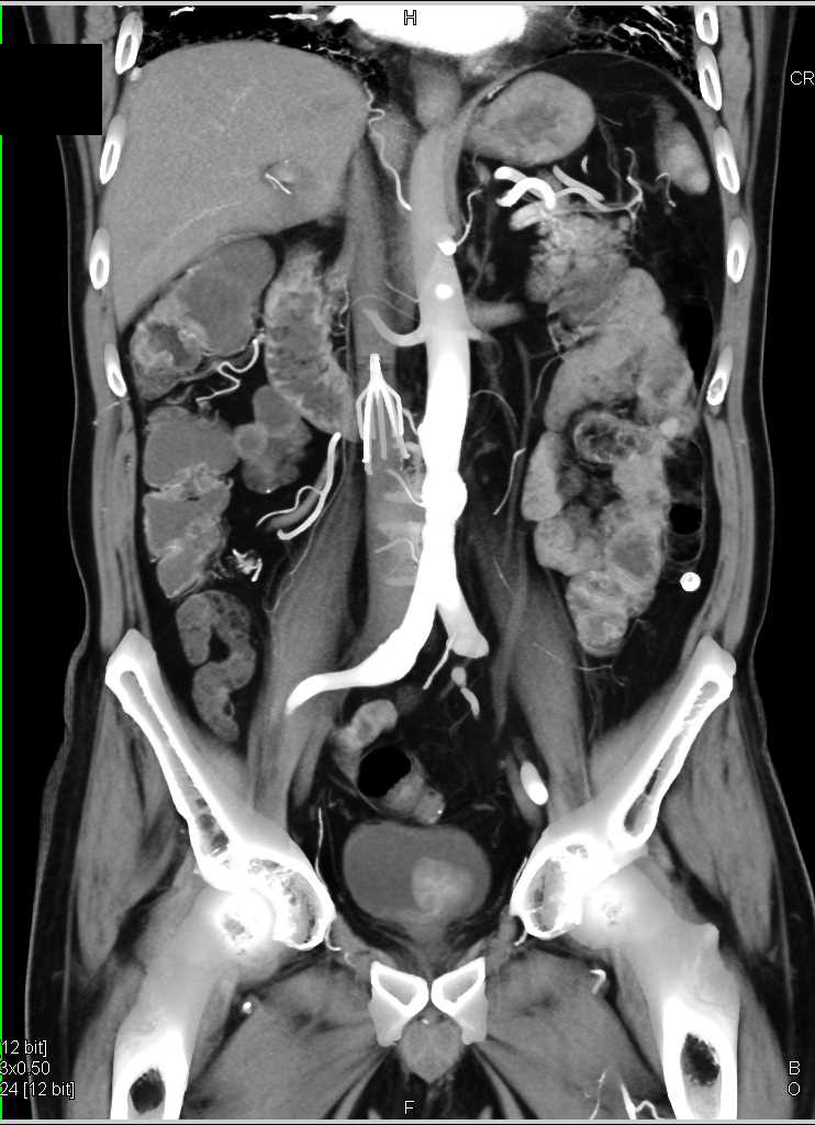 Incidental Bladder Cancer - CTisus CT Scan