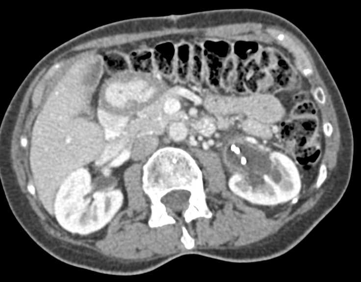 Carcinoma Left Ureter with Stent in Place - CTisus CT Scan