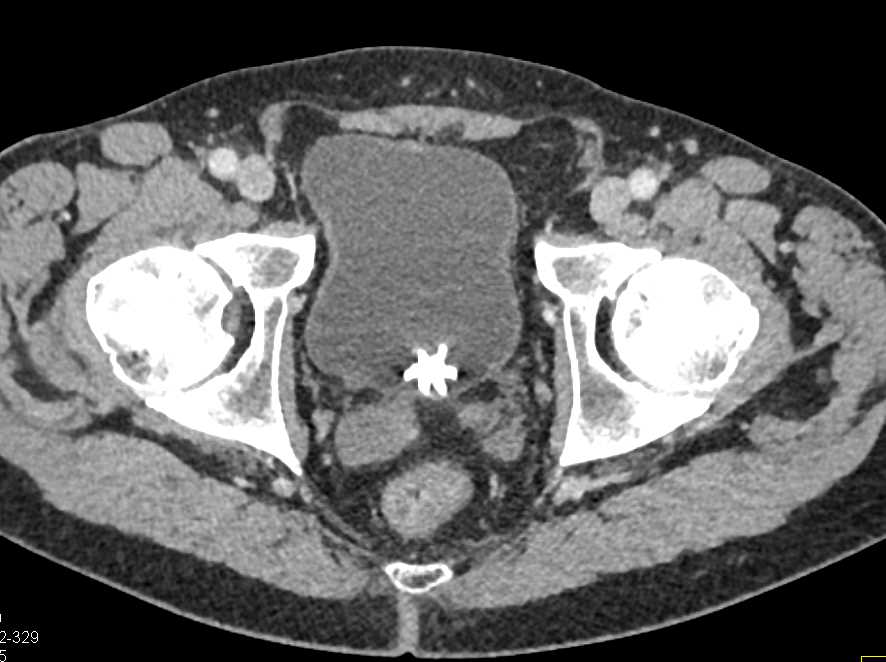 Bladder Calculus - CTisus CT Scan