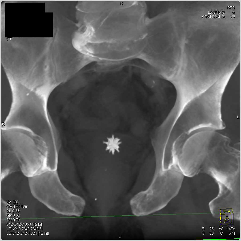 Bladder Calculus - Genitourinary Case Studies - CTisus CT Scanning