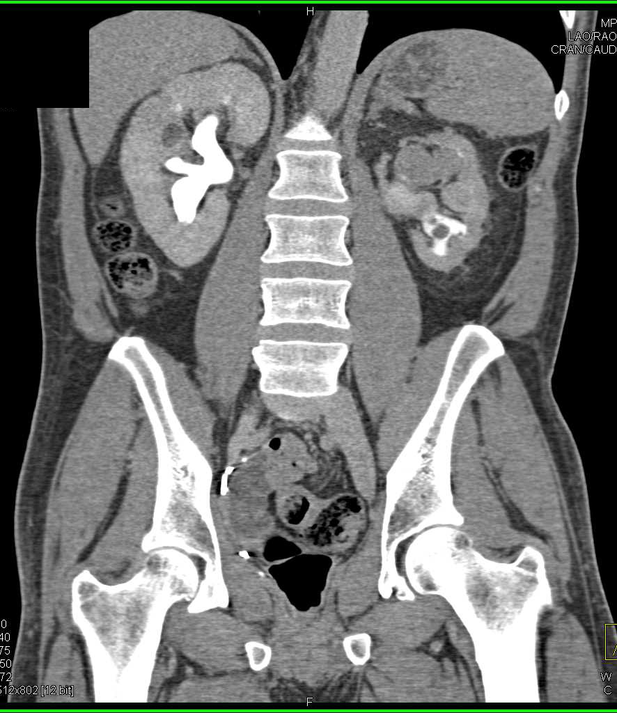 Transitional Cell Cancer (TCC) Recurrence in Left Ureter and Renal Pelvis - CTisus CT Scan