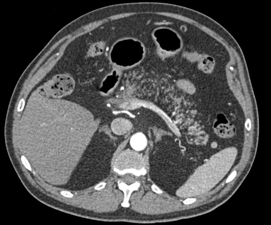 CT Cystogram with Leak from Urethra and Osteomyelitis Symphysis Pubis - CTisus CT Scan