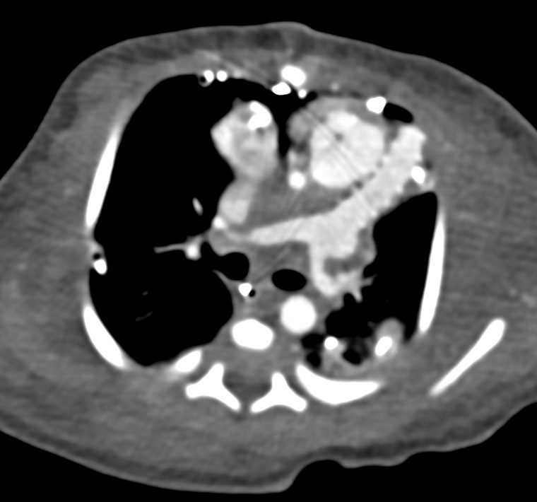 Poor Function Left Kidney - CTisus CT Scan