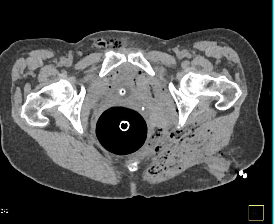 GSW Pelvis with Bladder Hematoma and Contrast Extravasation - CTisus CT Scan