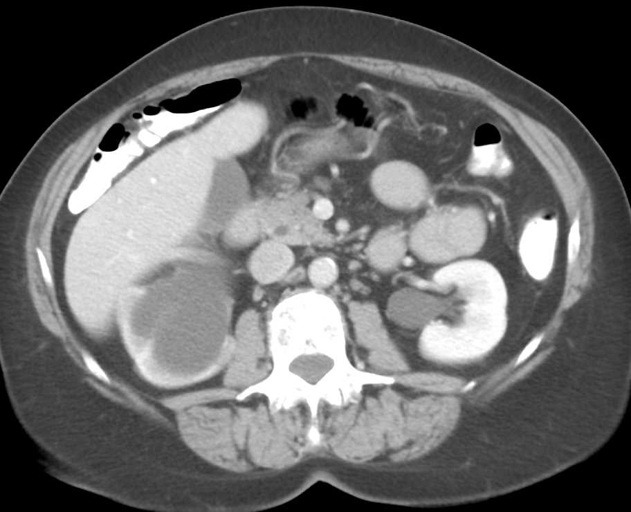 Bladder Cancer Obstructing the Right Ureter - CTisus CT Scan