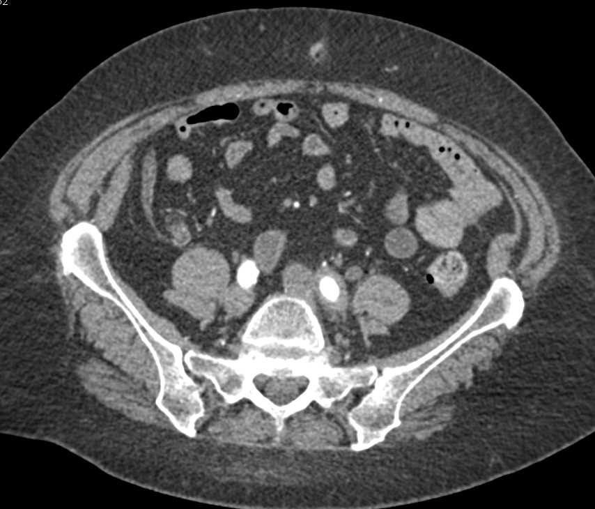 Bladder Cancer Obstructs the Left Ureter - CTisus CT Scan