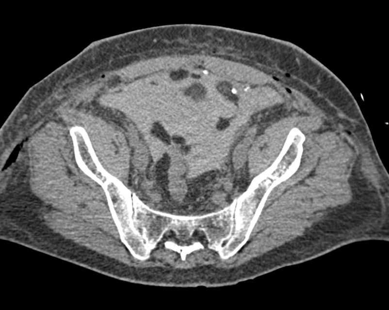 Hemoperitoneum in this Post Operative Patient - CTisus CT Scan