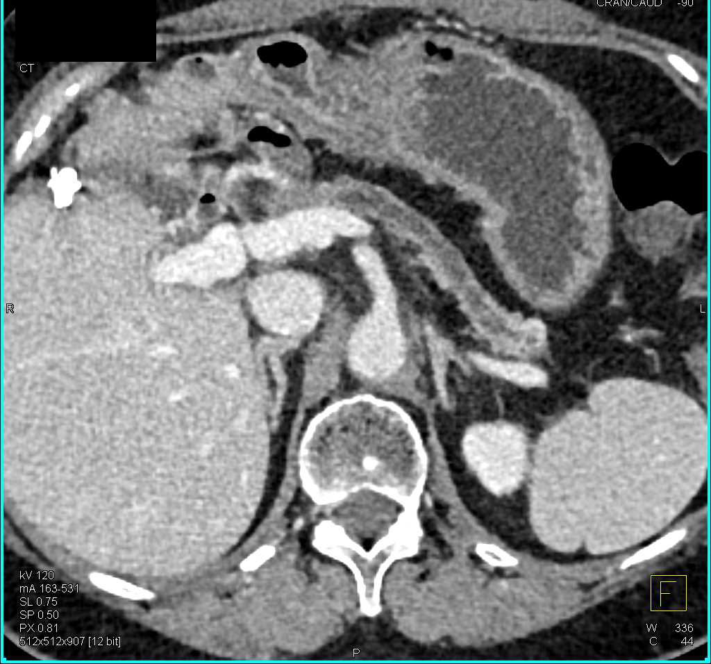 Incidental Bladder Cancer in Patient with Prior Whipple Procedure - CTisus CT Scan