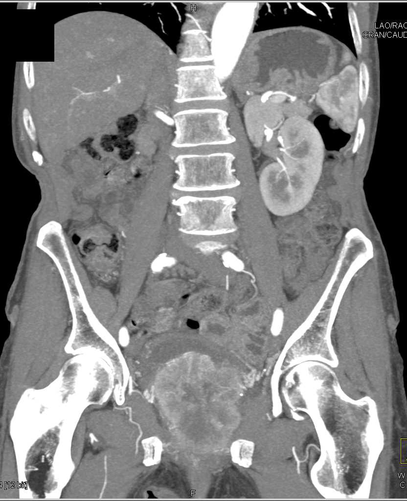 Sarcoma of the Bladder - CTisus CT Scan