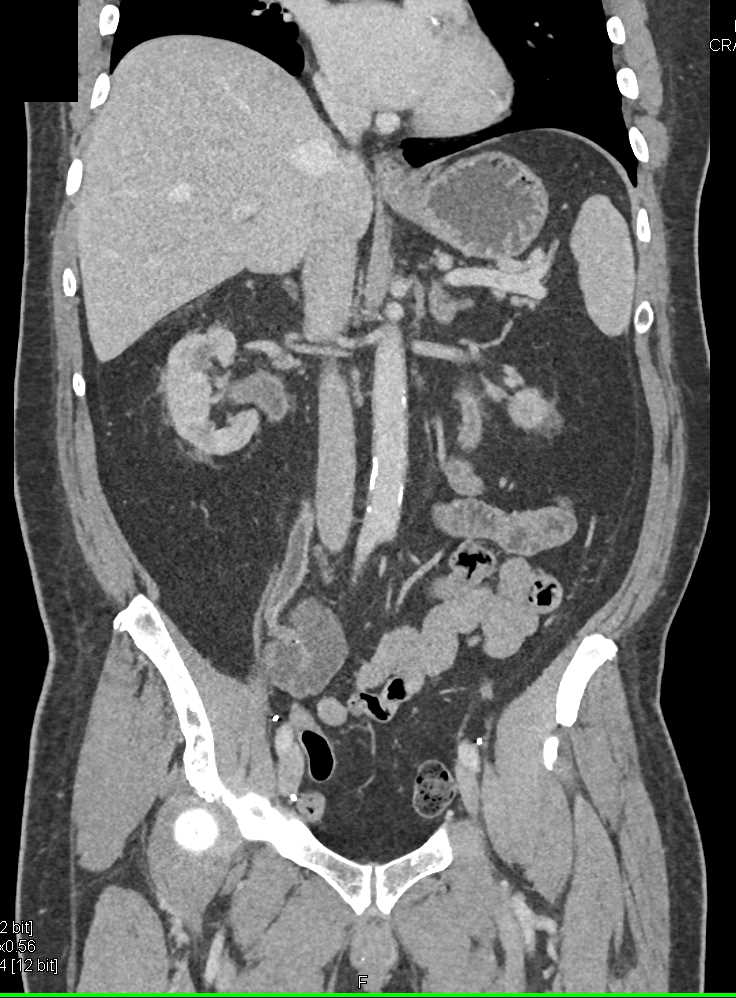 Recurrent Transitional Cell Carcinoma Involves the Left Ureter and Pelvis - CTisus CT Scan