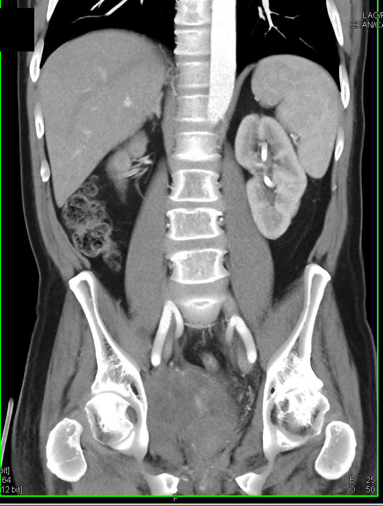 Invasive Bladder Cancer Invades Right Pelvic Sidewall - CTisus CT Scan