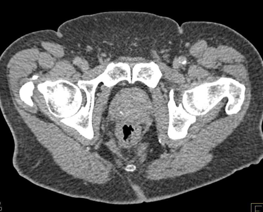 Urethral Carcinoma - CTisus CT Scan