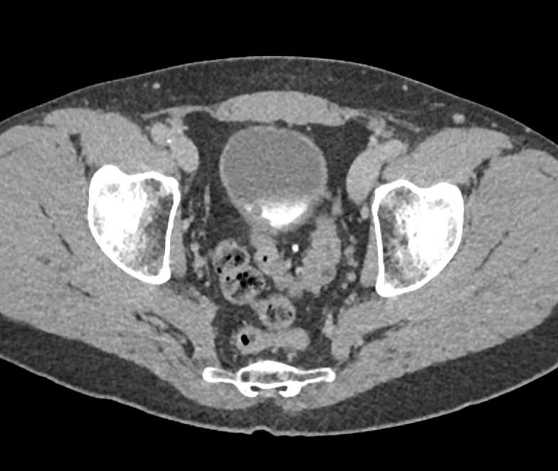 Incidental Bladder Cancer with Hematuria - CTisus CT Scan