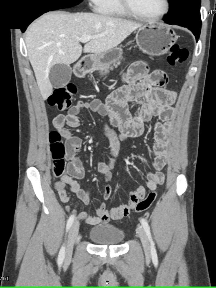 Stone in the Distal Right Ureter - CTisus CT Scan