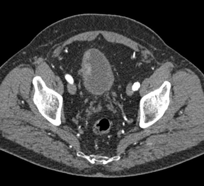 Carcinoma of the Right Bladder Wall - CTisus CT Scan