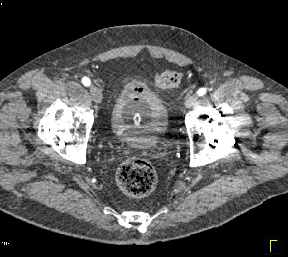 Bladder Cancer with Hardware Related Artifact - CTisus CT Scan