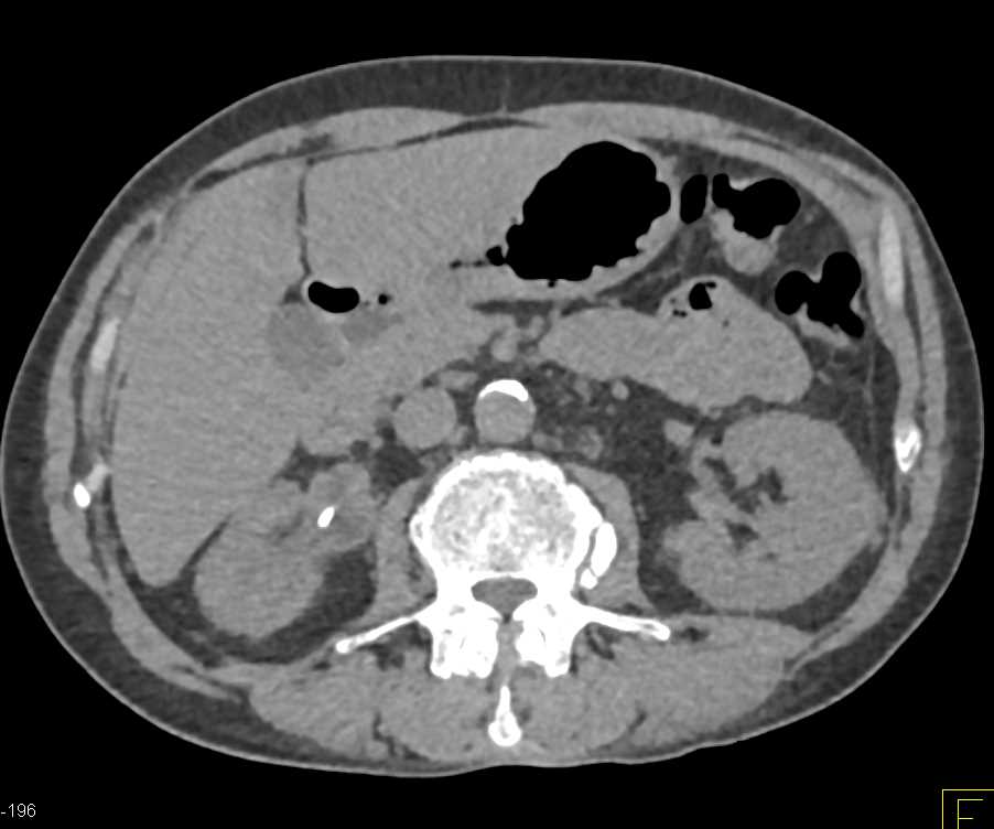 Transitional Cell Carcinoma in the Proximal Right Ureter - CTisus CT Scan