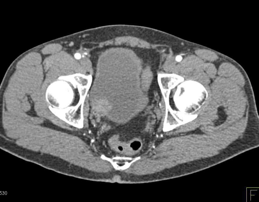 Bladder Cancer as an Incidental Finding - CTisus CT Scan