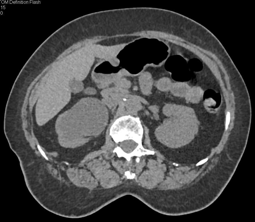 Obstructed Right Kidney due to a Transitional Cell Cancer (TCC) of the Ureter - CTisus CT Scan