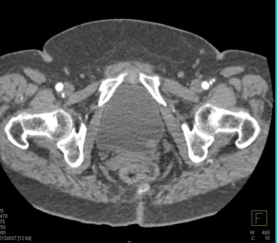 Incidental 1cm Bladder Cancer - CTisus CT Scan