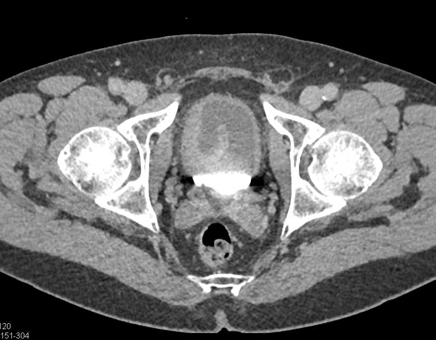 Bladder Cancer in Right Wall of the Bladder - CTisus CT Scan