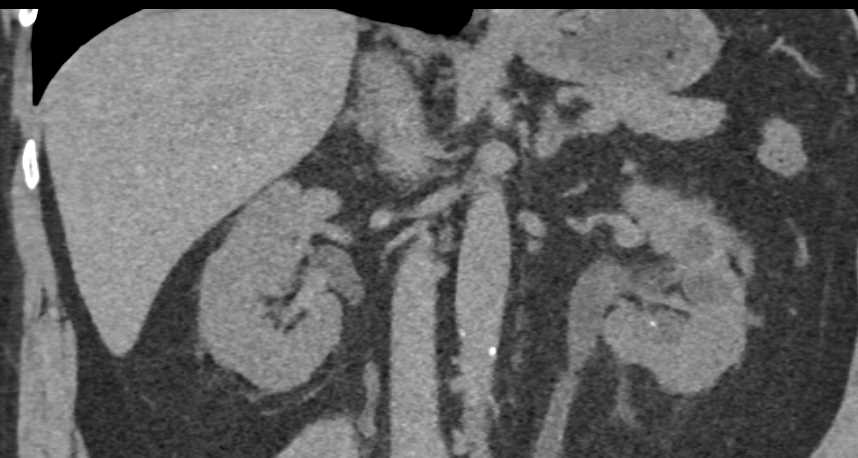 Transitional Cell Carcinoma Left Kidney and Bladder - CTisus CT Scan