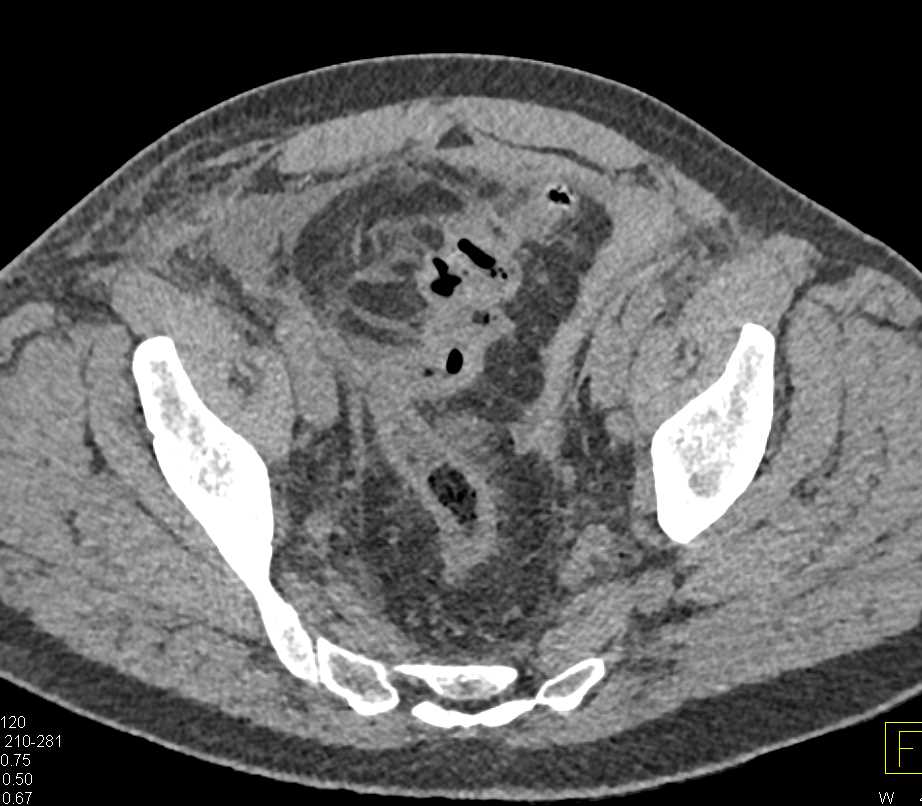 CT Cystogram with Bladder Perforation - CTisus CT Scan