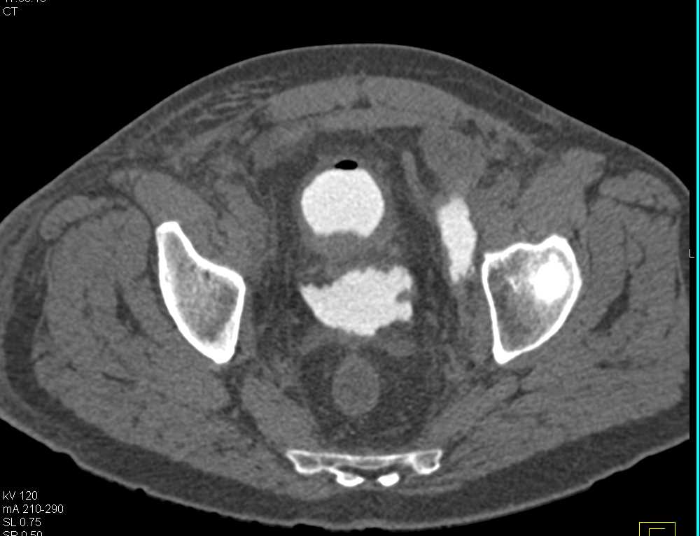 CT Cystogram with Bladder Perforation from Urethra Bladder Junction - CTisus CT Scan